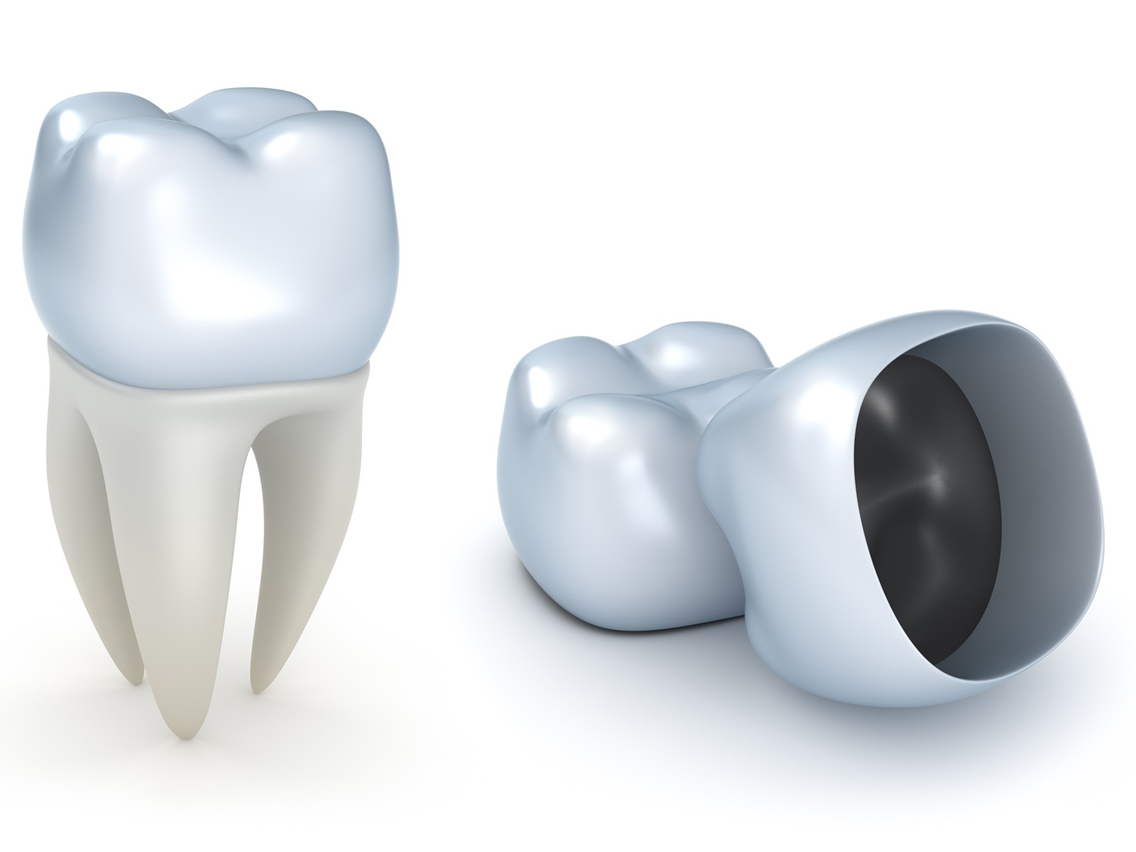 Can Dental Crown get Cavities?