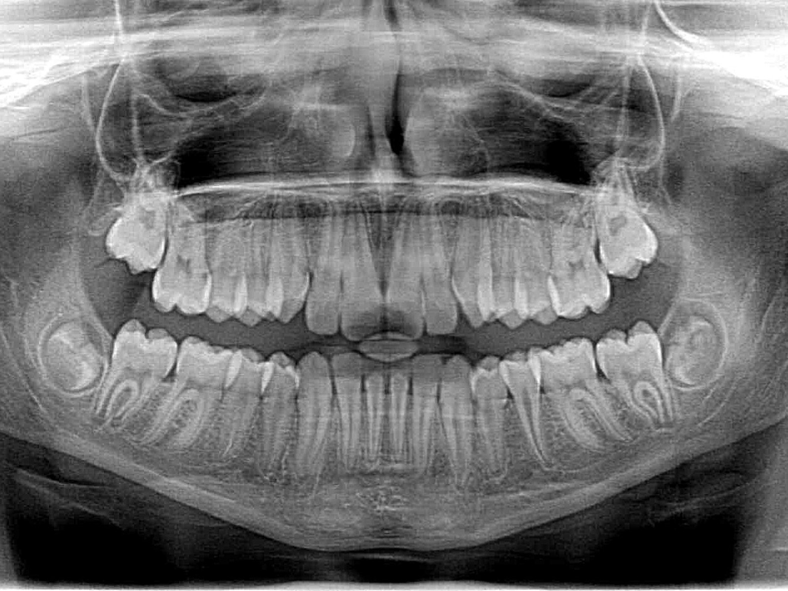 How Are Dental X-Rays Advantages?