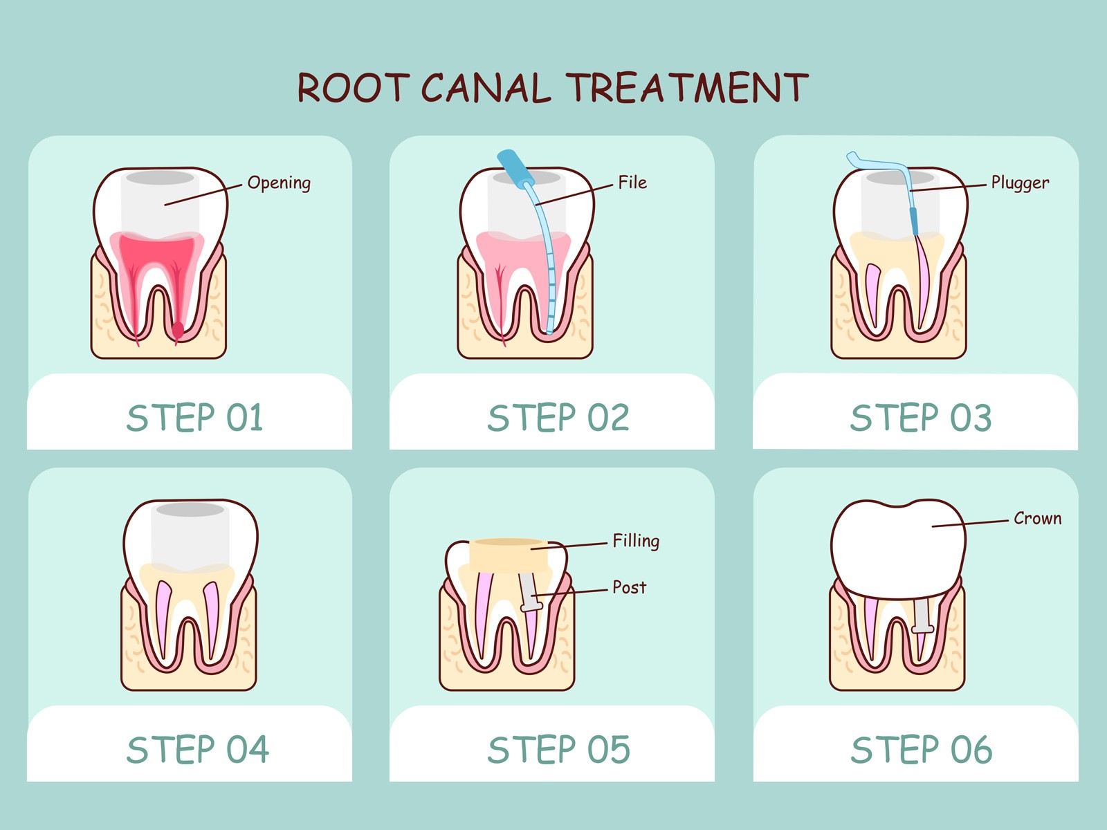 What You Need To Know About Root Canal Treatment