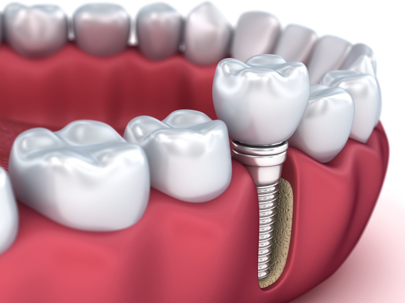 What Are the Advantages of Dental Implants Over Bridges
