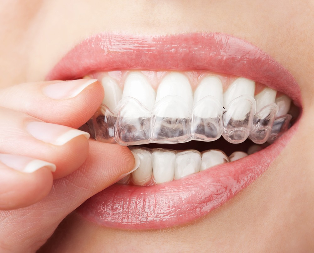 How Invisalign Changes Your Face
