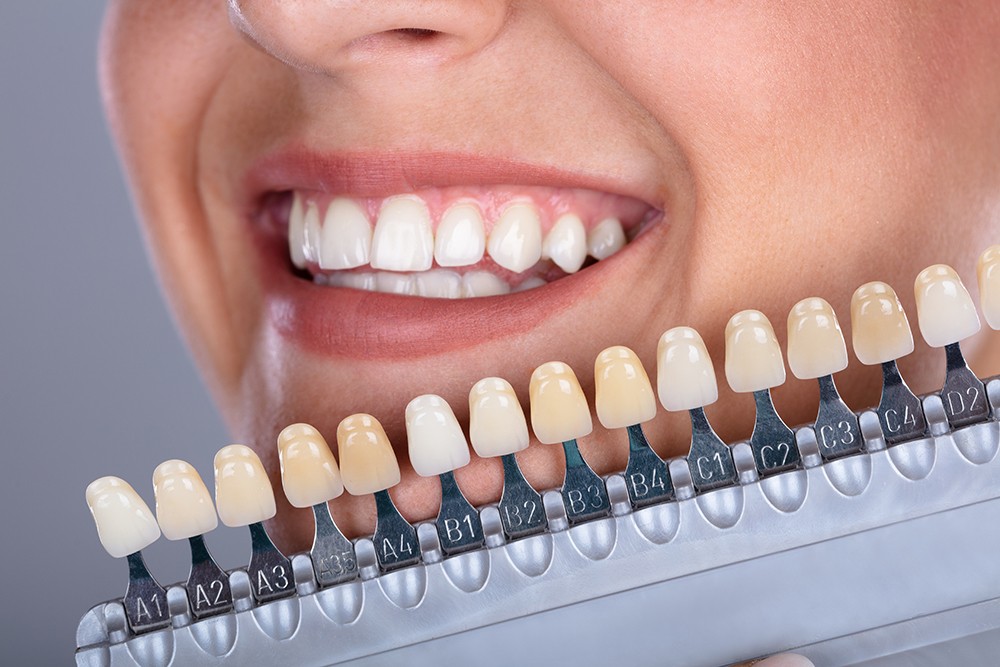 How Long Teeth Whitening Takes?