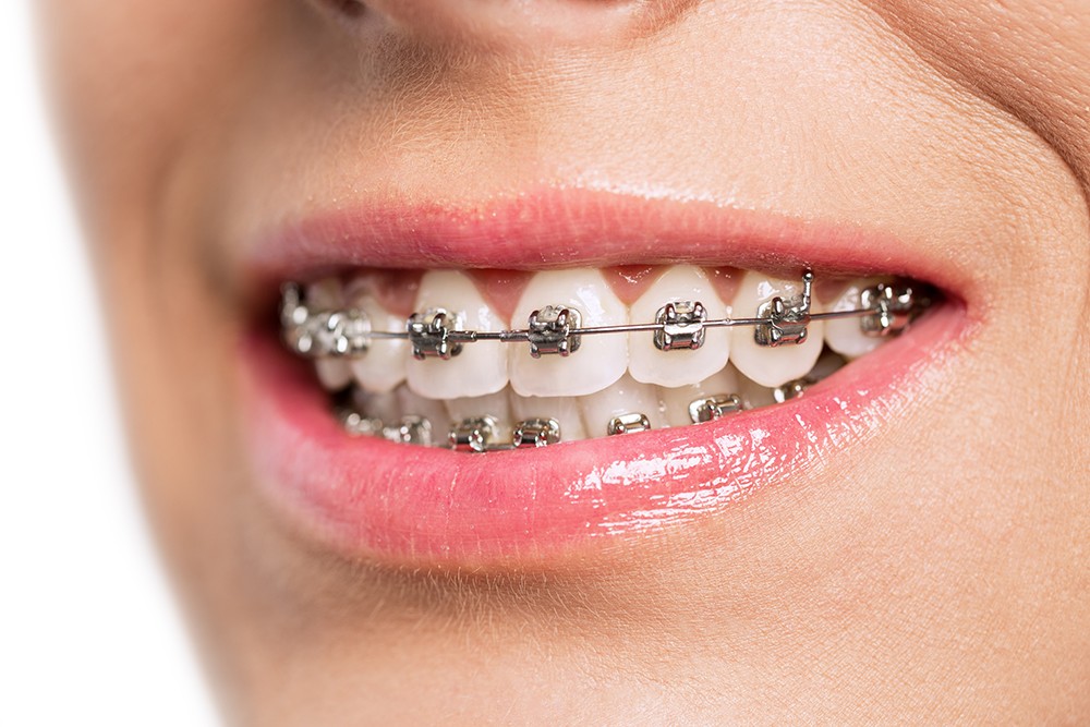 How Braces Are Fixed