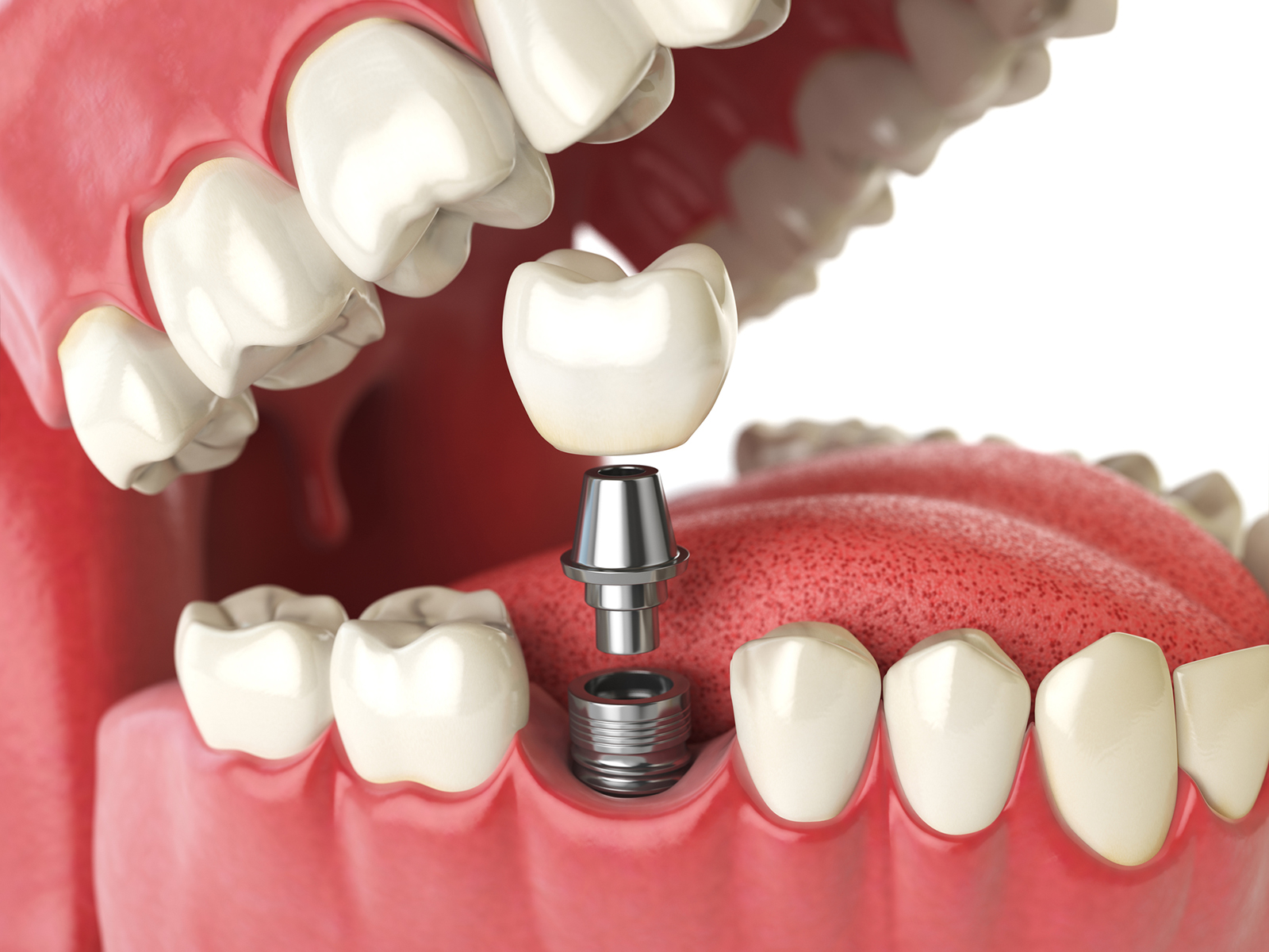 Difference between implant-supported crown and abutment crown?