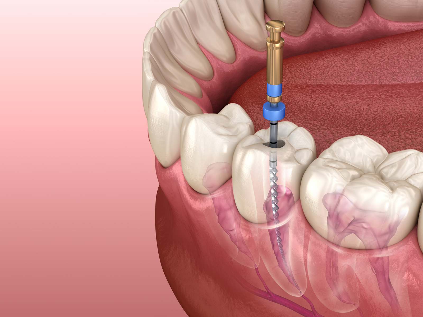 Will antibiotics cure an infected root canal?