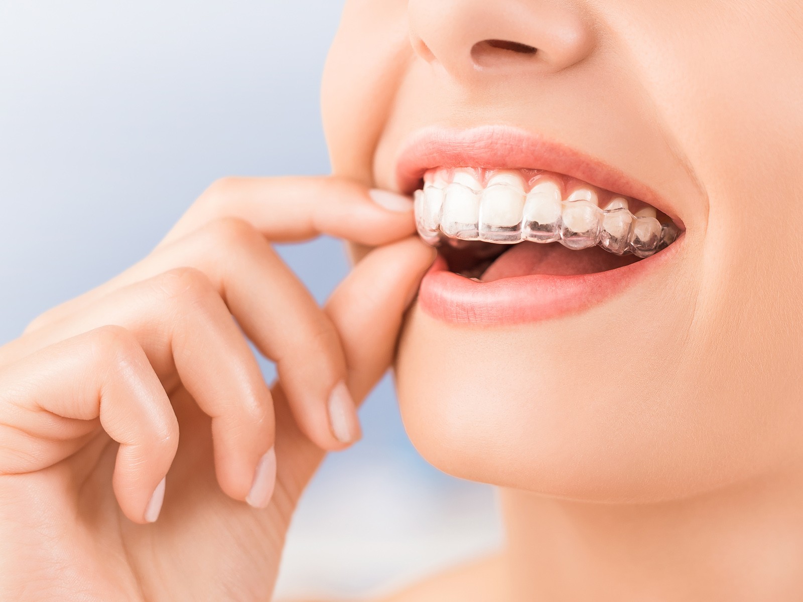 Do I have to brush my teeth every time I eat with Invisalign?