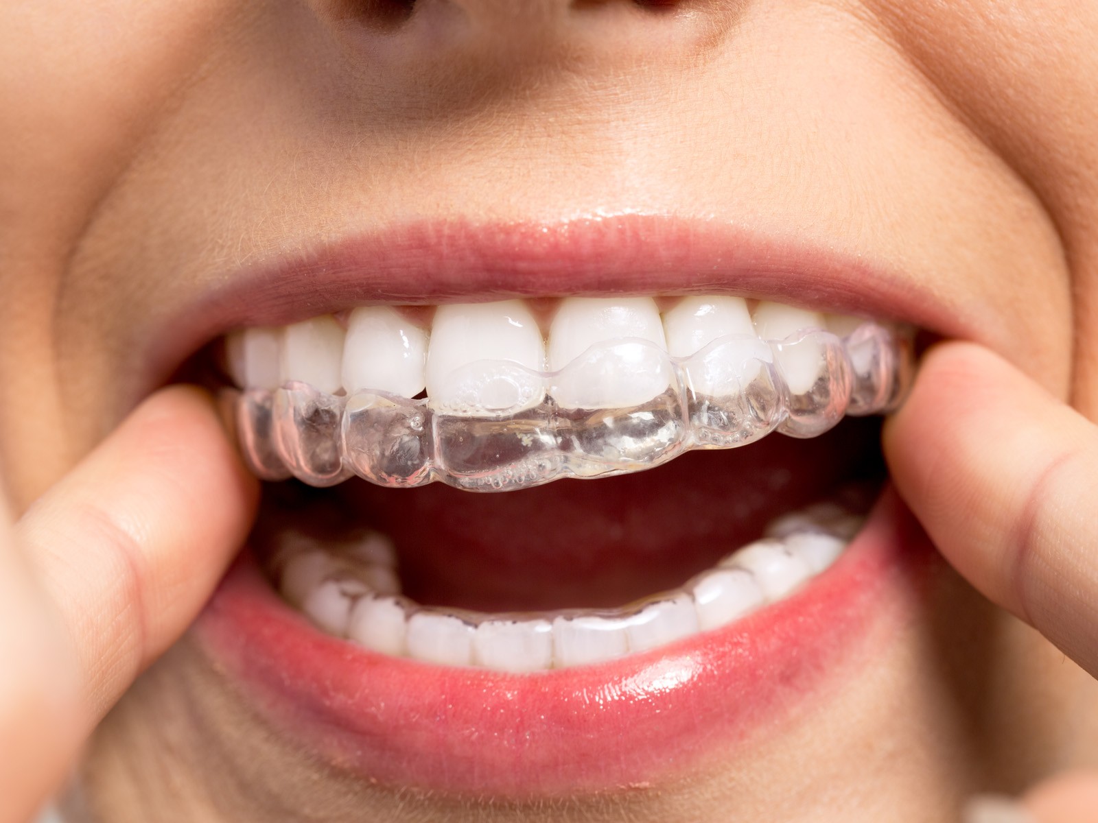 How are Invisalign attachments removed?