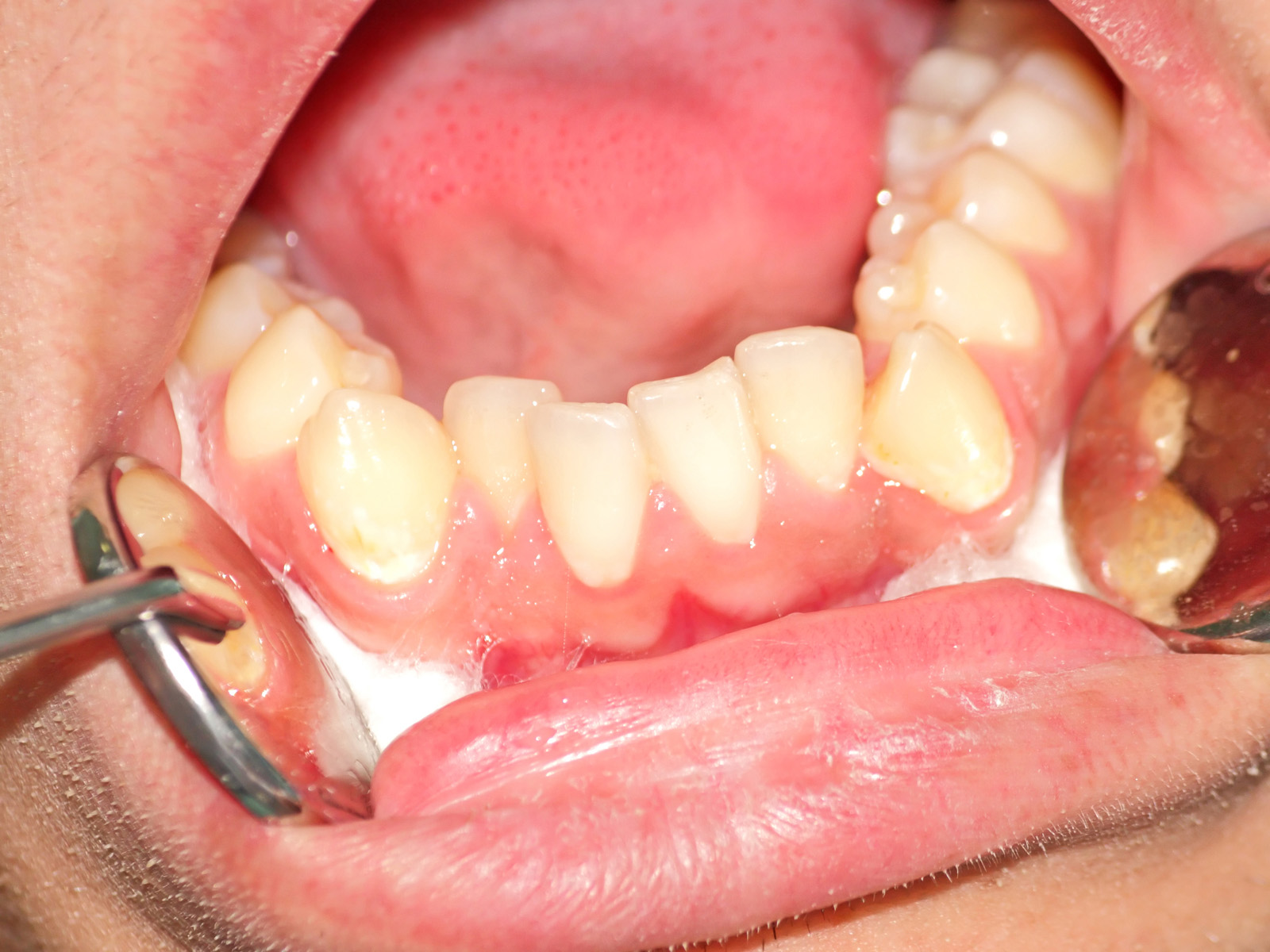What is a bicuspid in relation to dental health?