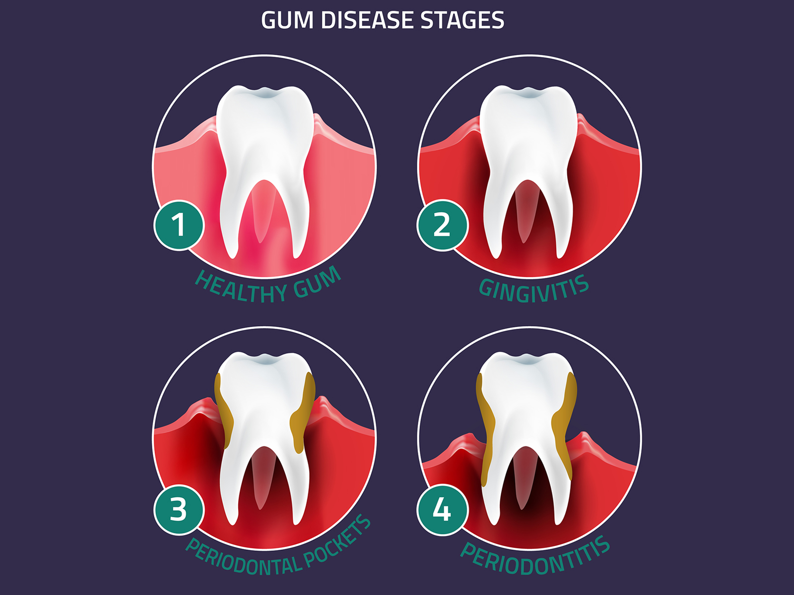 What are the 4 stages of gum disease?