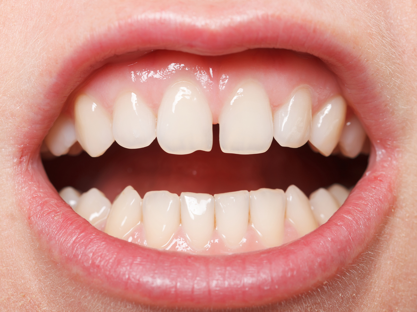How Does Diastema Affect My Oral Health?