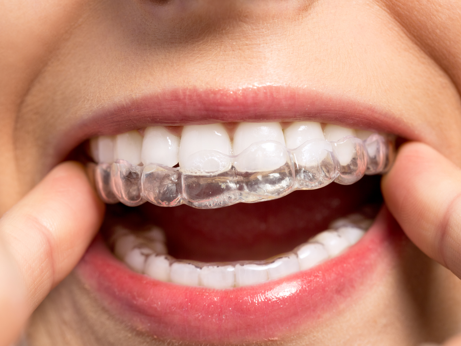 Maintaining Your Results After Invisalign Treatment
