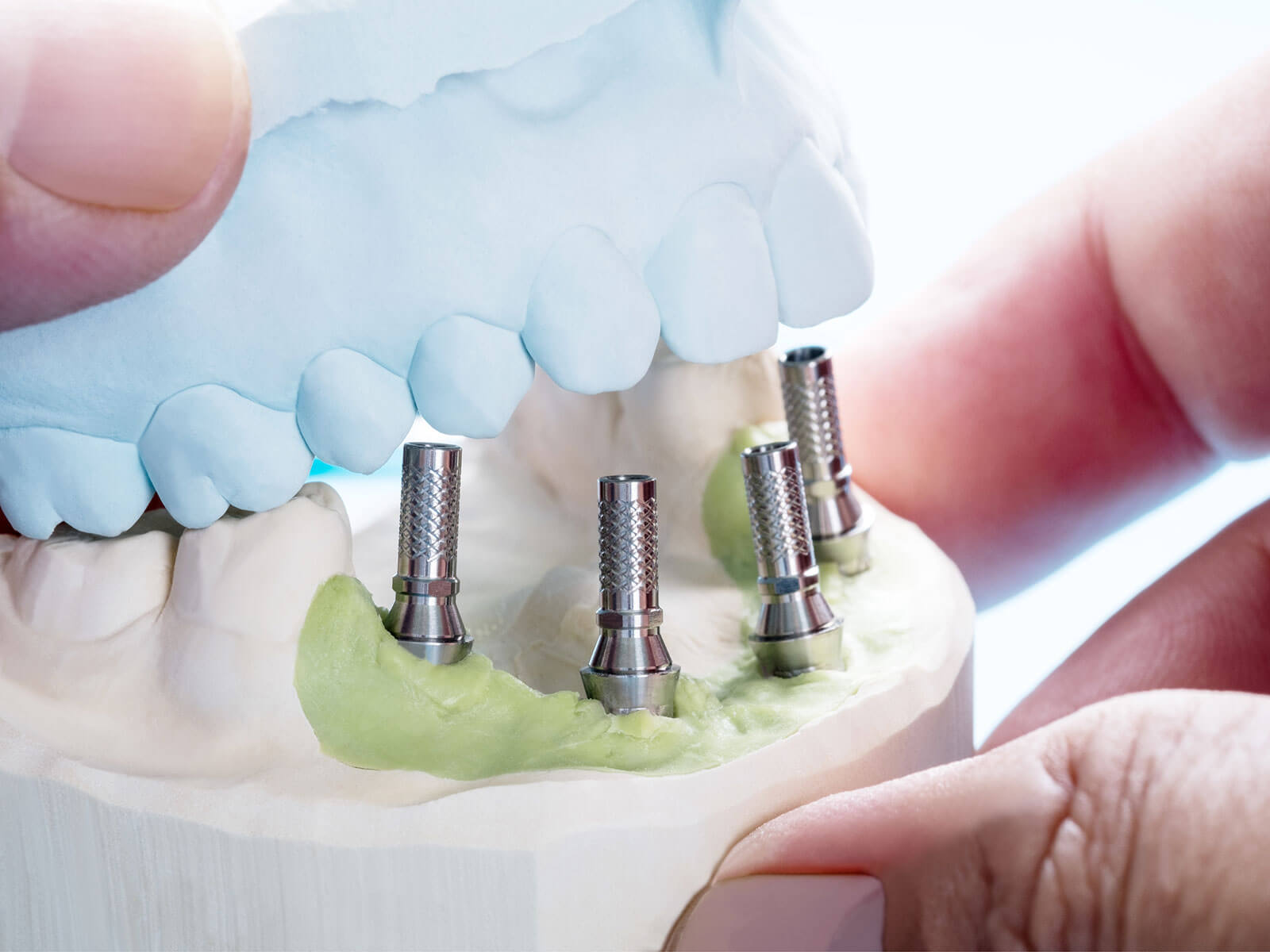 4 Incredible Benefits of Same-Day Dental Crowns