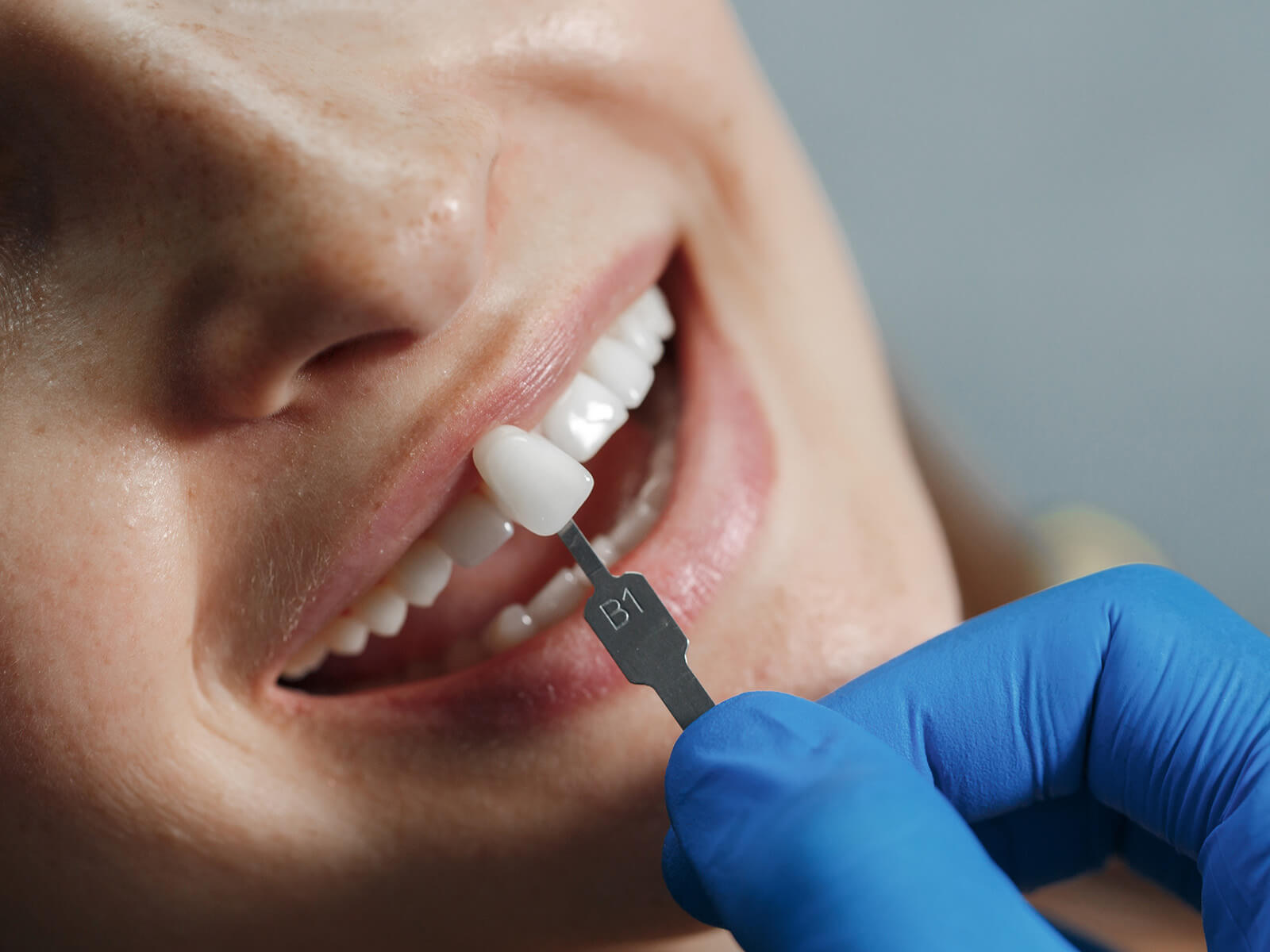 A Quick Guide to Dental Crowns for Your Front Teeth