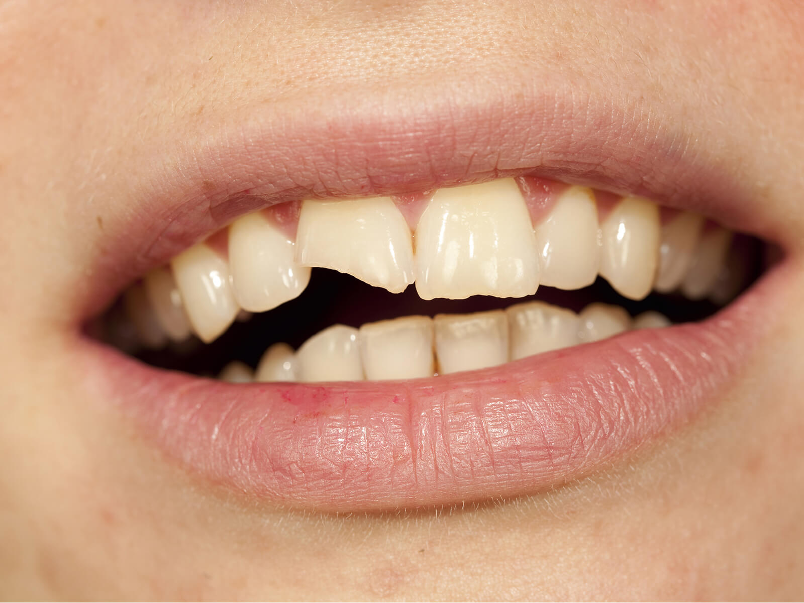 5 Ways To Protect Your Oral Health If You Break or Chip A Tooth