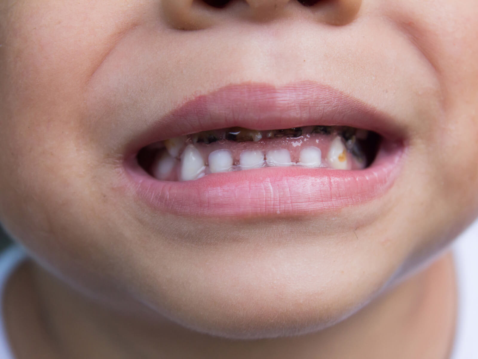 What Causes Rotten Teeth in Kids?