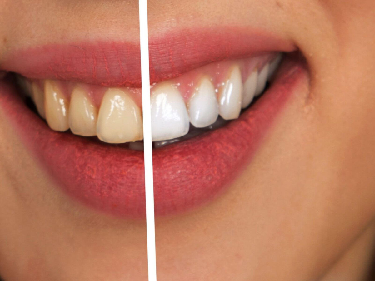 How To Remove Tobacco Stains From Teeth Quickly And Effectively