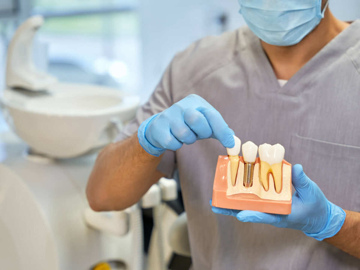 Essential Things To Know About Dental Implants