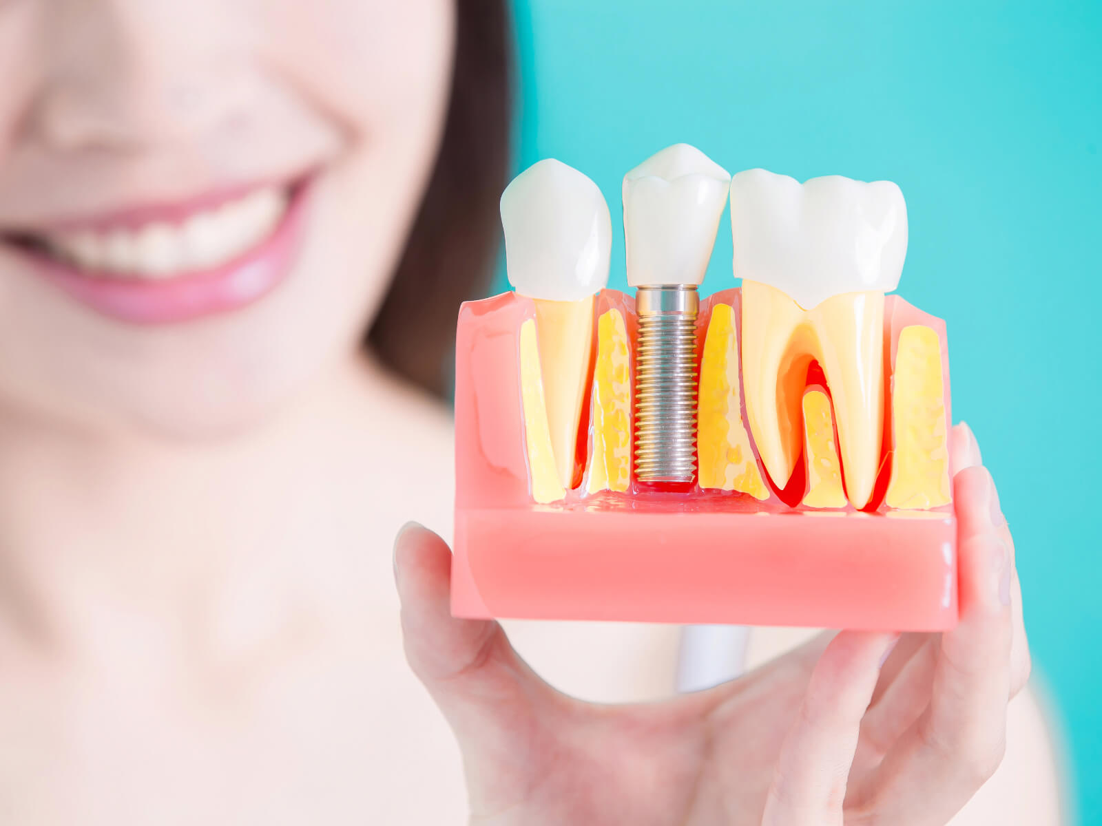 The Role of Bone Grafting in Dental Implant Success