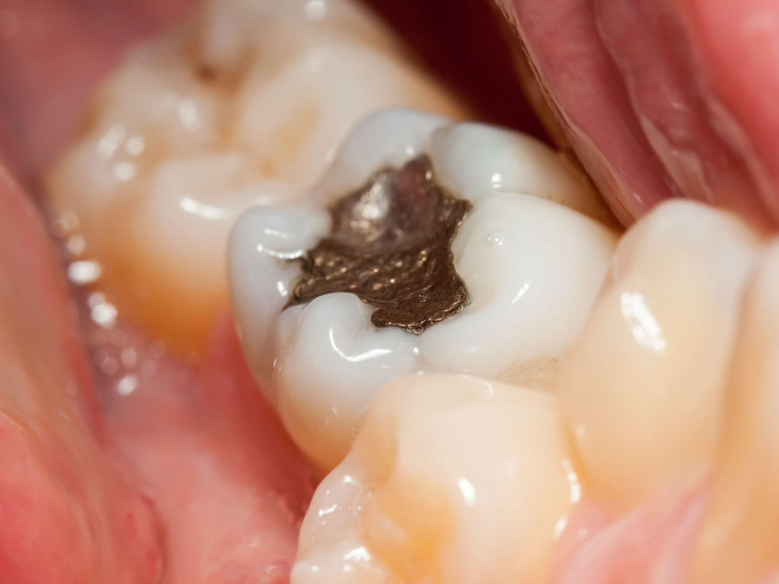Amalgam vs White Fillings: Dental Fillings Explained