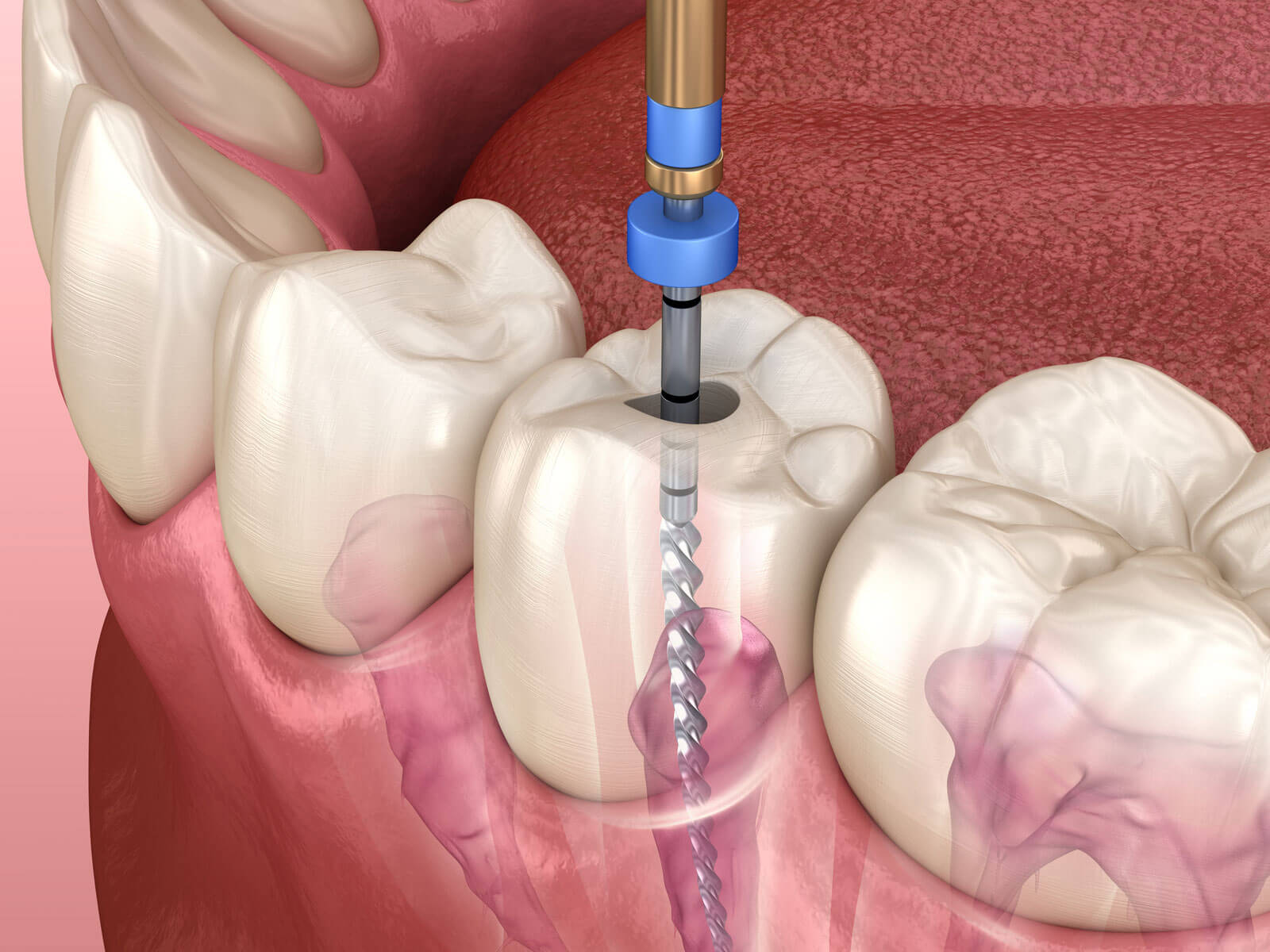 5 Signs You Might Need a Root Canal