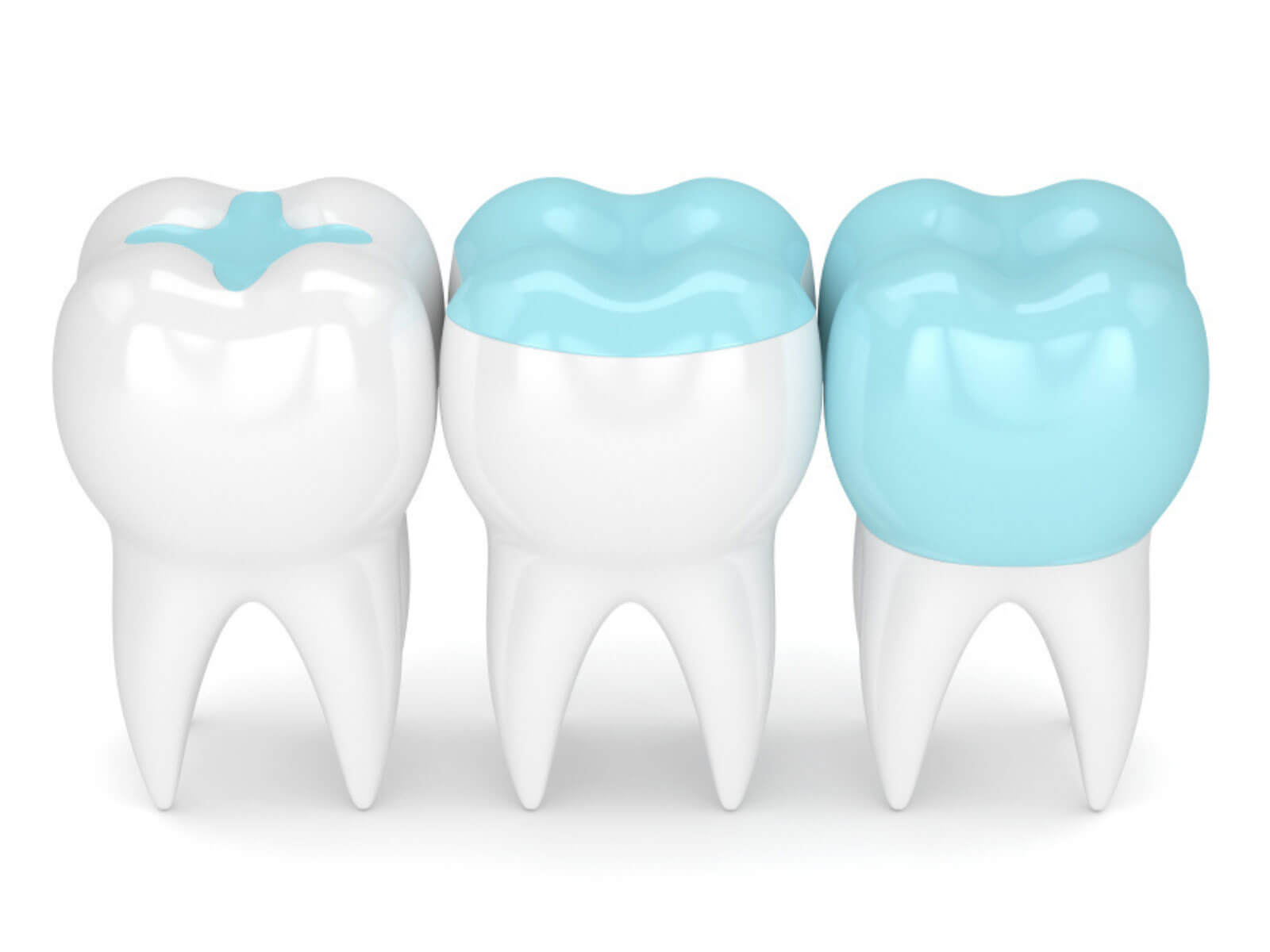 Dental Inlay vs. Filling: What’s the Difference?