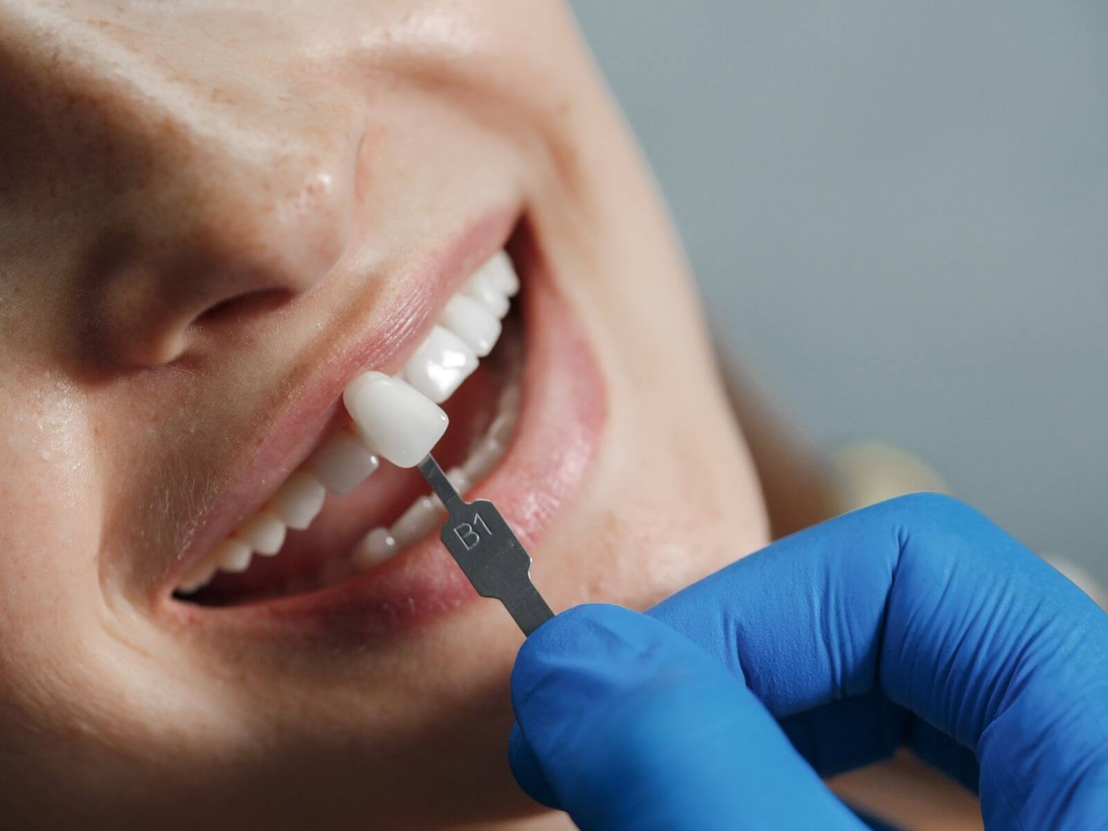 Disadvantages of Dental Crowns: 8 Risks and Side Effects to Know
