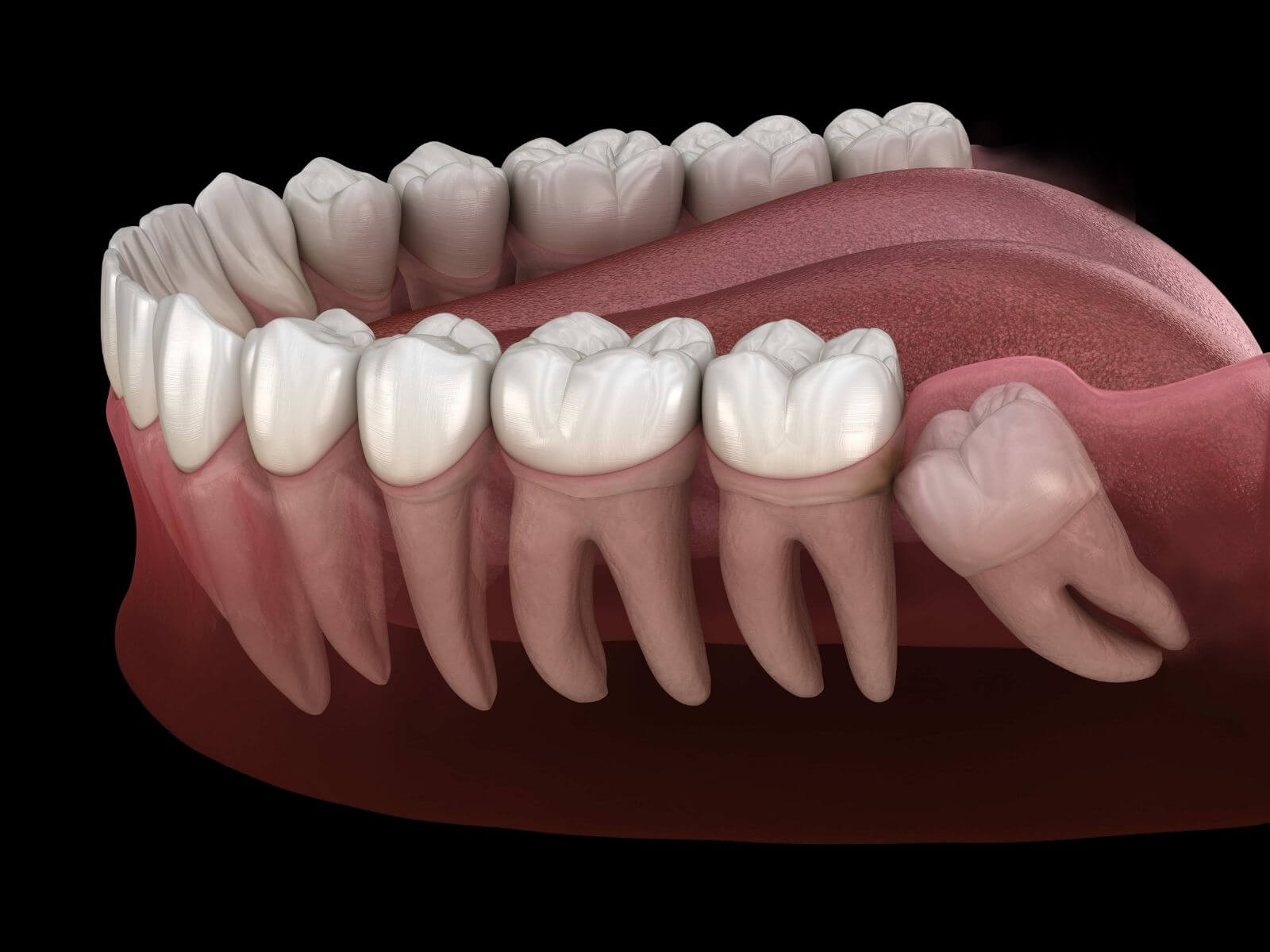 Why Are They Called Wisdom Teeth? The History Behind the Name