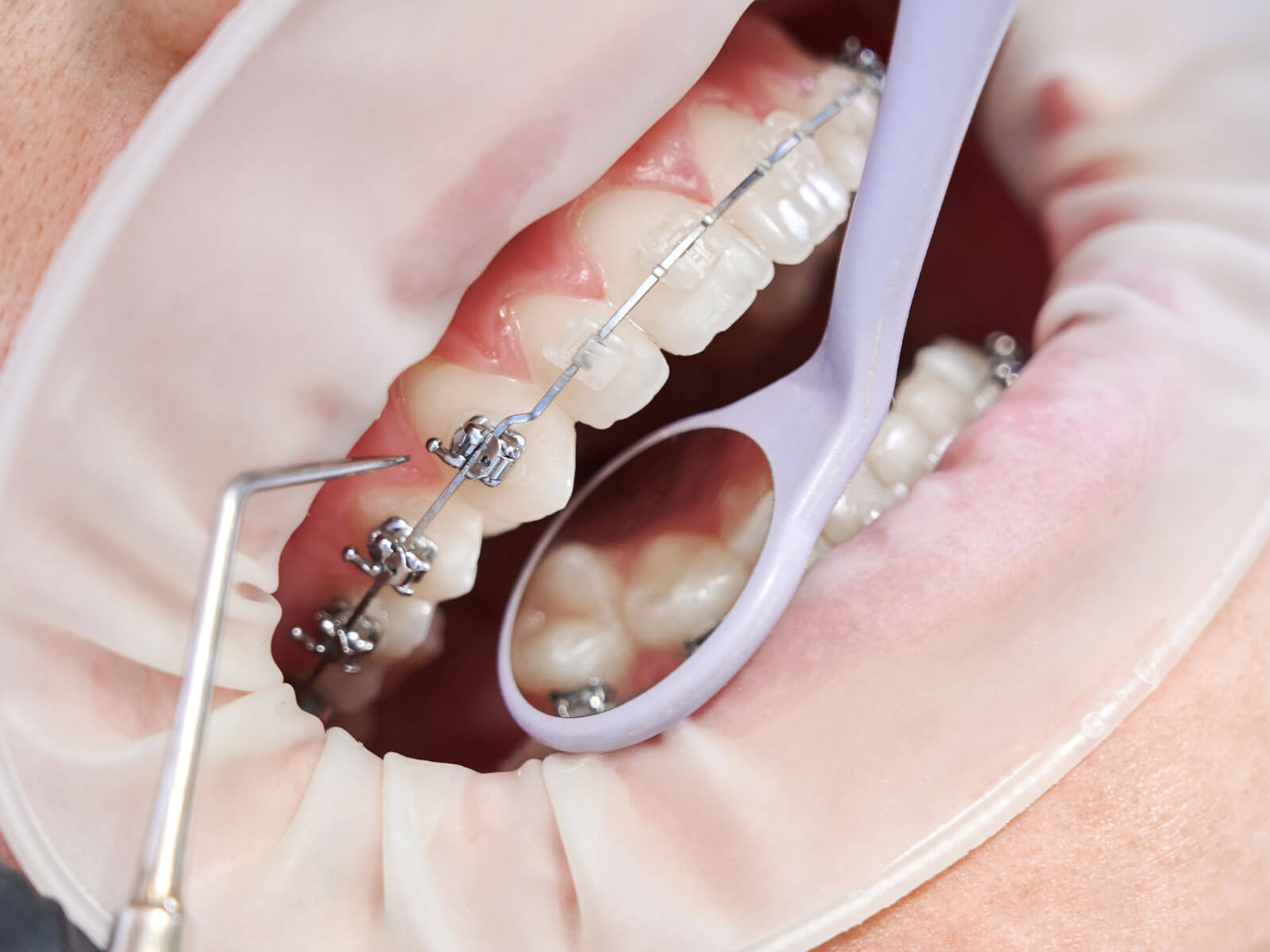 How Much Do Braces Cost in 2026? By Type, With/Without Insurance