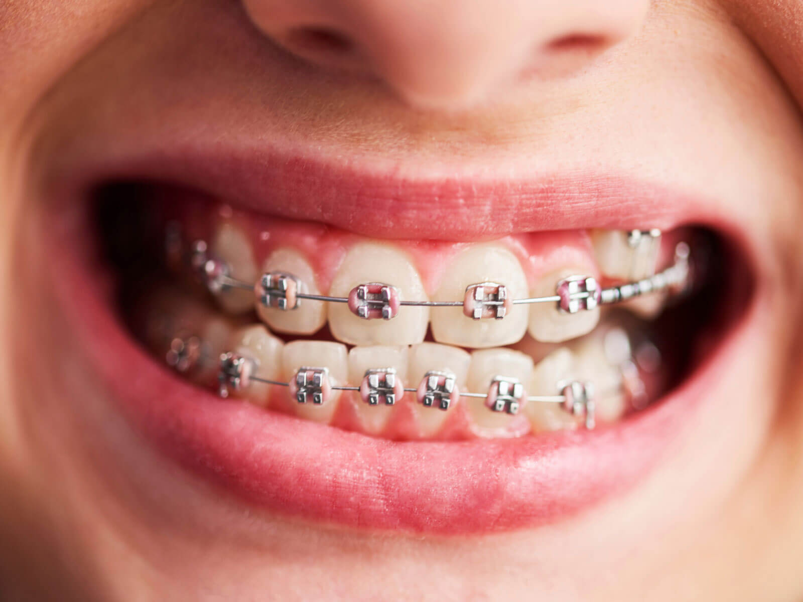 Busting the Most Common Braces Myths